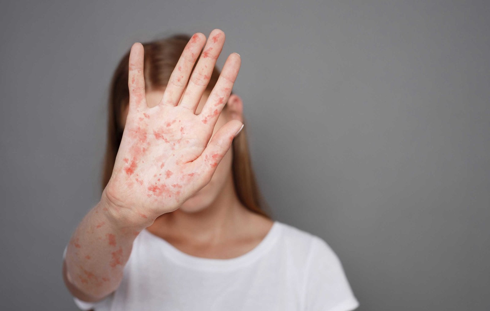 Brasil entra em alerta máximo por surtos de sarampo